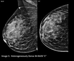 After a mammogram that didn't show anything, and a sonogram that found the lump, i was diagnosed with stage 2 breast cancer. Your Patient Got A Dense Breast Notification With Her Mammogram Report What Are You Supposed To Do Christianacare News