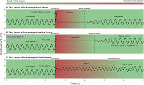 Image result for Rest Tremor