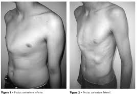 Pectus carinatum is almost always treated with a brace, and not with surgery. Pectus Carinatum Surgery Or Bracing Braceworks Custom Orthotics