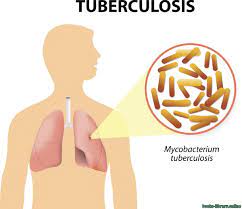 Tuberculosis (tb) is a contagious infection that usually attacks your lungs. Ù‚Ø±Ø§Ø¡Ø© ÙˆØªØ­Ù…ÙŠÙ„ ÙƒØªØ§Ø¨ Ø§Ù„Ø³Ù„ Tuberculosis 2021