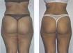 Mesoterapia : Contro Cellulite e Grasso