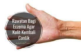 Penyakit kulit yang biasa dijumpai tetapi kurang difahami. Rawatan Bagi Eczema Agar Kulit Kembali Cantik Bebelsihat Com