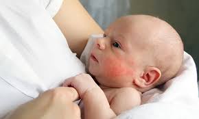 Image result for sweat rash on back baby