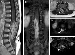 Image result for Spinal Epidural Abscess
