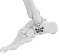 Evans Osteotomy Plate - Lower Extremity Fixation - TriMed Inc.