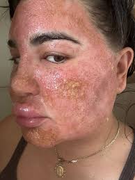 Swelling After Laser