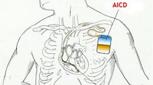 Un desfibrilador es un dispositivo que envía energía eléctrica o descarga al corazón. Desfibrilador Implantable Consejos En El Dia A Dia