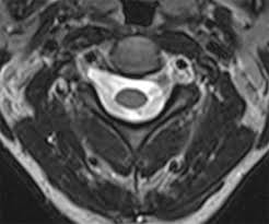 Non Degenerative Disease Of The Peripheral Nerves Radsource