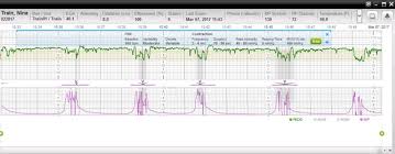 Fetal Strip Analytics Centricity Perinatal Users Group