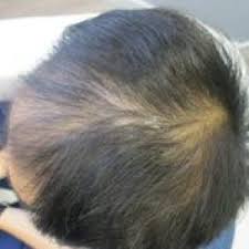 Despite the current treatment options for different types of alopecia, there is a need for more effective management options. Low Level Laser Therapy Is Effective Seeing Is Believing Surehair International