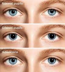 A student under the direct supervision of a teacher or professor. Dilated Pupils Pupil Dilation Causes Symptoms