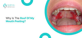 Image result for Oral herpes roof of mouth