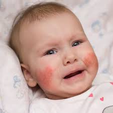 The most common type of eczema is atopic. Applying Live Bacteria To Skin Improves Eczema