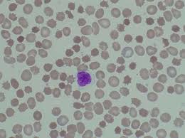 red blood cell inclusions and abnormalities hematology