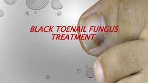 Black Toenail Fungus Treatment