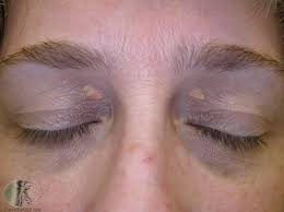 Image result for xanthelasma of eyelid