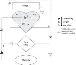 Image result for Delayed Transition from Fetal Circulation
