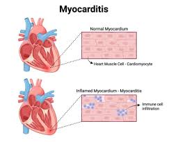 Image result for Myocarditis