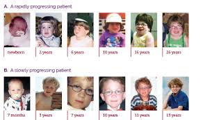 Rate Of Progression Hcp