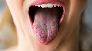Image result for black tongue symptoms