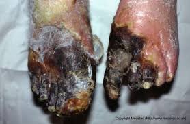 The process involves swelling of the nucleus (pyknosis), fragmentation of the nucleus (karyorrhexis) and complete dissolution of the nuclear chromatin (karyolysis). Necrotic Wounds Woundsource