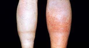 4 Blood Clot Symptoms Not To Ignore