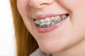 Self Ligating Brackets Market Research With American Orthodontics Biomers Pte Ltd G H R Orthodontics Ormco Corporation Dentsply Rocky Mountain Orthodontics The Manomet Current