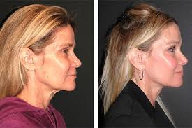 16:55 et, jun 9 2021; Mini Facelift Best Mini Facelift By Dr Andrew Jacono
