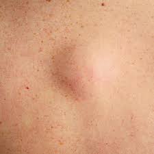 What S That Random Bump On Your Body Women S Health Lipomaarmpit Skin Bumps Red Skin Spots Skin Spots