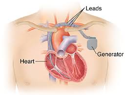 Нозология (international classification of diseases alexander demidov); Biventricular Pacemaker And Icd Biventricular Icd Saint Luke S Health System