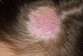 As well as not knowing what causes alopecia barbae, we also don't know how long it takes for beard hair to grow back and the treatments for it aren't all that effective. Women S Hair Loss Causes Treatments And Solutions