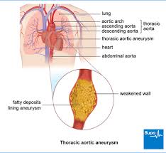 thoracic aortic aneurysm health information bupa uk