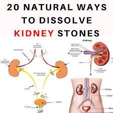 20 Natural Ways To Dissolve Kidney Stones Home Crafting Kidney Stones Remedy Kidney Stones Kidney