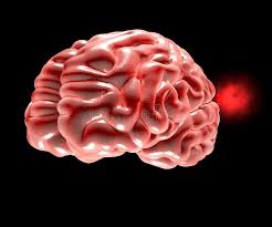 É muito recorrente confundirmos essa disfunção arterial com um acidente vascular cerebral, entretanto, não é a você acorda com uma forte e intensa dor de cabeça. Aneurisma Cerebral Cabeca Do Cerebro Ilustracao Stock Ilustracao De Vascular Kidney 38297852