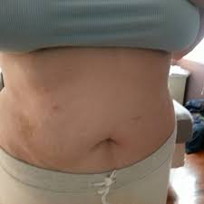 This is a more complicated type of gastric bypass. Post Pic Of Your Scars Post Operation Weight Loss Surgery Q A Bariatricpal