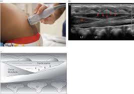 The lateral approach allows you to avoid the supraspinous and interspinous ligaments, which are often crunchy and calcified in older patients. Ultrasound Guided Lumbar Puncture Chapter 17 Pediatric Emergency Critical Care And Ultrasound