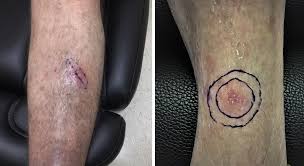 Image result for Pigment stains on the shin