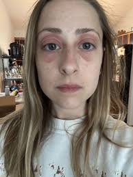 Homeowner blames household mold for ugly selfies and poor health