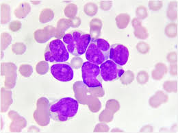 La leucemia mieloide cronica (lmc) è un tumore delle cellule del sangue, caratterizzato dalla proliferazione incontrollata delle cellule staminali midollari. Historia Aguda De La Leucemia Mieloide