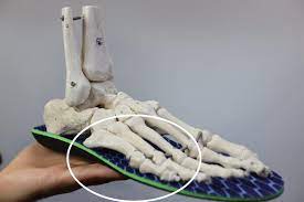 More common on the 2nd and 3rd metatarsals but can occur in the 5th metatarsal on the outside of the foot also. Foot Pain Along The Outside Of The Foot Causes Best Home Treatment