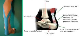 Il tendine di achille è il tendine più grande del corpo umano e ha una funzione biomeccanica molto importante: La Lesione Del Tendine Di Achille Dott Volpe Giuseppe