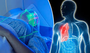 Primary lung cancer (also called adenocarcinoma) starts in the lung itself. Lung Cancer Targeted Proton Beam Treatment Could Stop Disease Express Co Uk