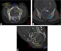 Image result for Pelvimetry