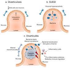 Ijms Free Full Text Role Of Inflammation In Pathophysiology Of Colonic Disease An Update Html