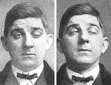 Myasthenia Gravis Wikipedia