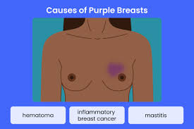 Image result for Inflammatory breast cancer