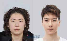 Anna is a communication expert and a life enthusiast. Men Plastic Surgery Before And After Videos Facebook