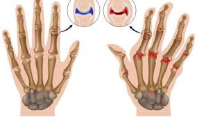 Managing Rheumatoid Arthritis Nps Medicinewise