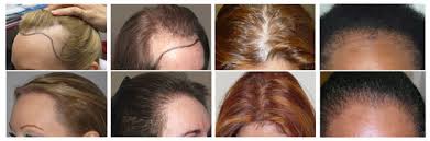 Here is what you need to know about this common type of. Hair Loss In Women Hair Centre In Ludhiana Punjab India