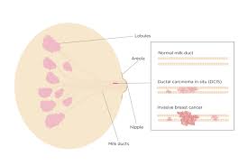 Policy and practice in relation to symptomatic women in breastscreen australia signs and symptoms to look out for: Ductal Carcinoma In Situ Dcis Breast Cancer Network Australia